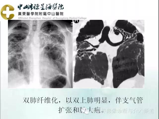关于肺结节病的那些胸片图,你都看懂了吗?