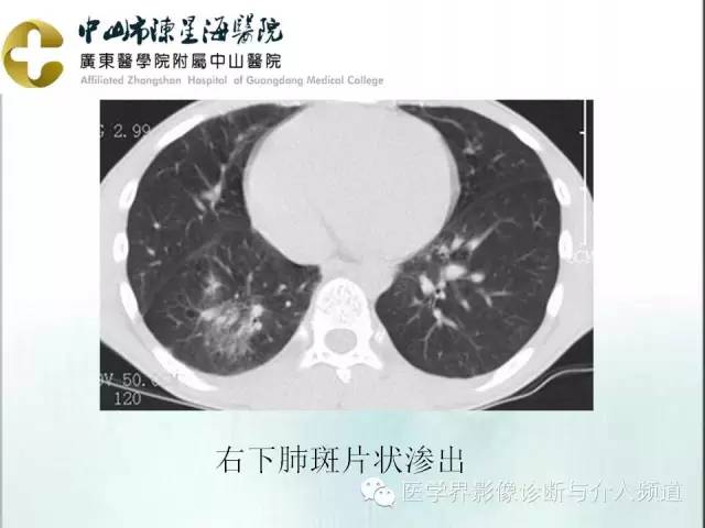 关于肺结节病的那些胸片图,你都看懂了吗?