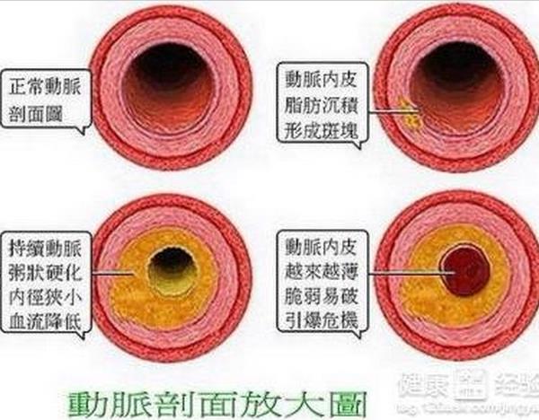 如何有效阻止高血脂向动脉粥样硬化发展?