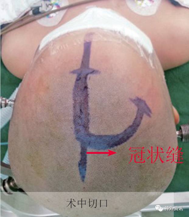吴斌教授:冠状缝前单额开颅的临床应用| 神经外科手术