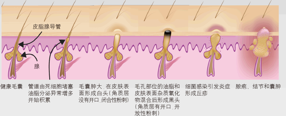 按照病理学痘痘分为/6类 1,激素痘痘 一般是青春痘,雄激素紊乱,经期