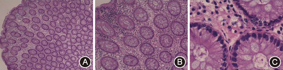 患儿结肠黏膜病理片:可见淋巴细胞及浆细胞炎性细胞间质浸润(he染色