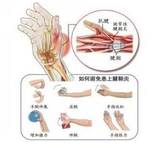 【健康科普】腱鞘炎的四大典型症状