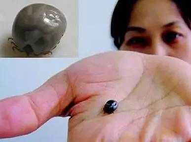 拨开看发现是蜱虫, 送去医院取出后发现 蜱虫已经是半个指甲盖大小了