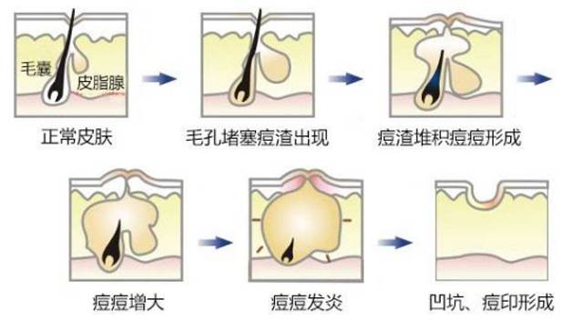 痘坑小恶魔 我要代表月亮消灭你