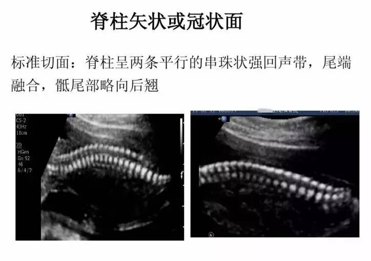 孕期各项超声检查标准切面,还看不懂报告的孕妈进