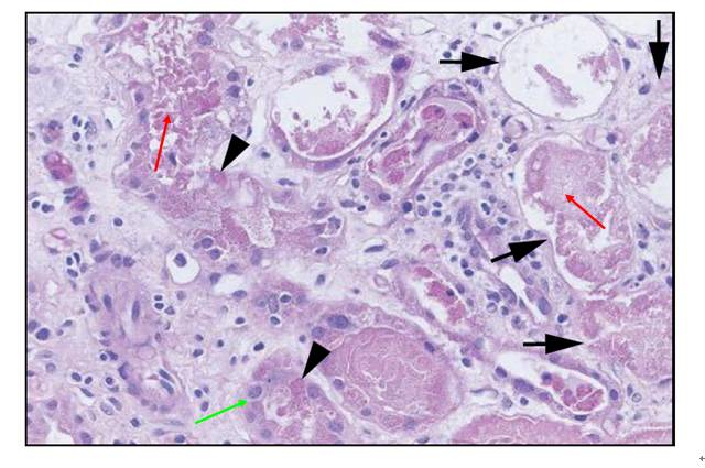 肾内病理图解:缺血性和毒性急性肾小管损伤