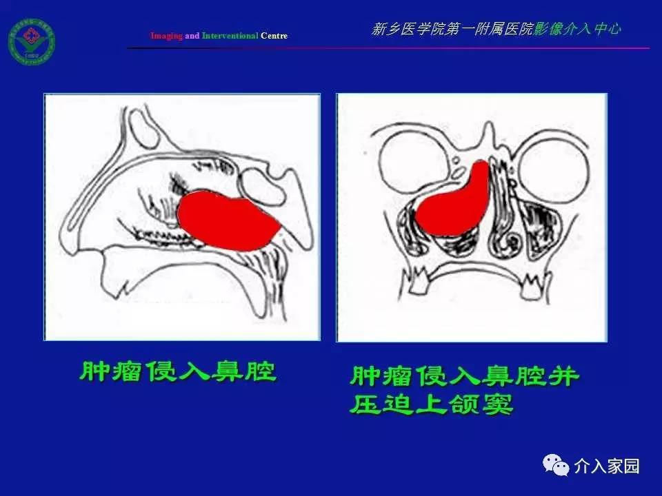 介入微课堂│鼻咽部纤维血管瘤影像学诊断与介入治疗