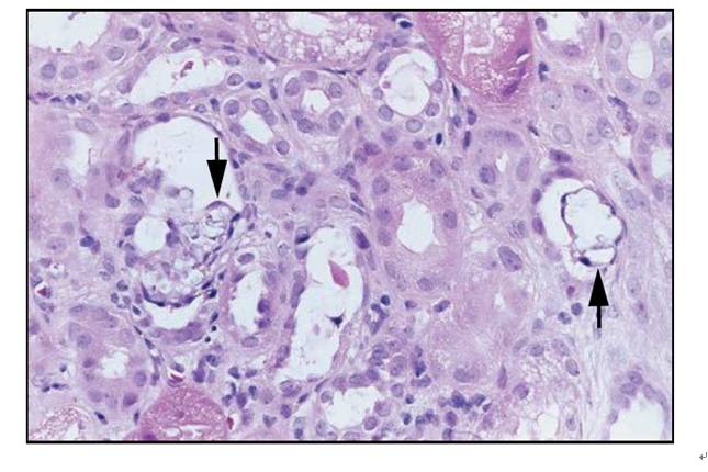 肾内病理图解:缺血性和毒性急性肾小管损伤