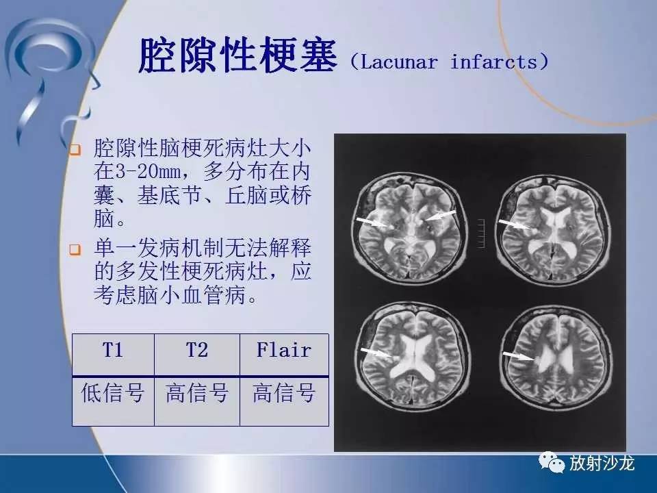 经典脑小血管病与腔隙性脑梗死