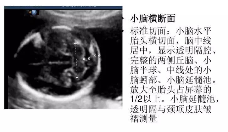 孕期各项超声检查标准切面,还看不懂报告的孕妈进