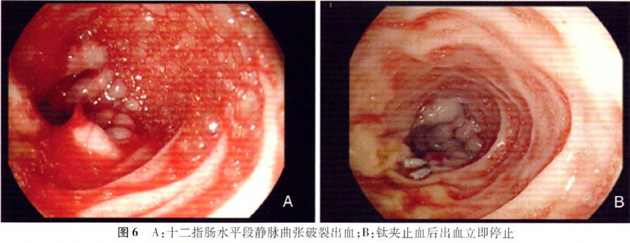 图文 食管胃静脉曲张破裂出血的内镜治疗