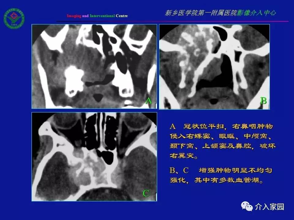 介入微课堂│鼻咽部纤维血管瘤影像学诊断与介入治疗