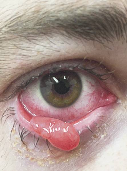 肉芽肿生长迅速,手术或外伤导致结膜损伤后数天至数周就可突破眼睑