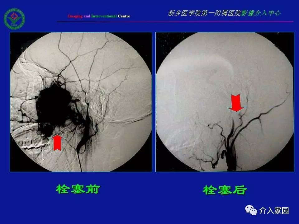 介入微课堂│鼻咽部纤维血管瘤影像学诊断与介入治疗