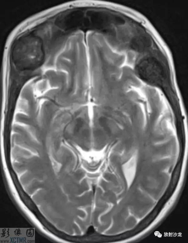 每日一例364期颅骨骨质破坏影像病例