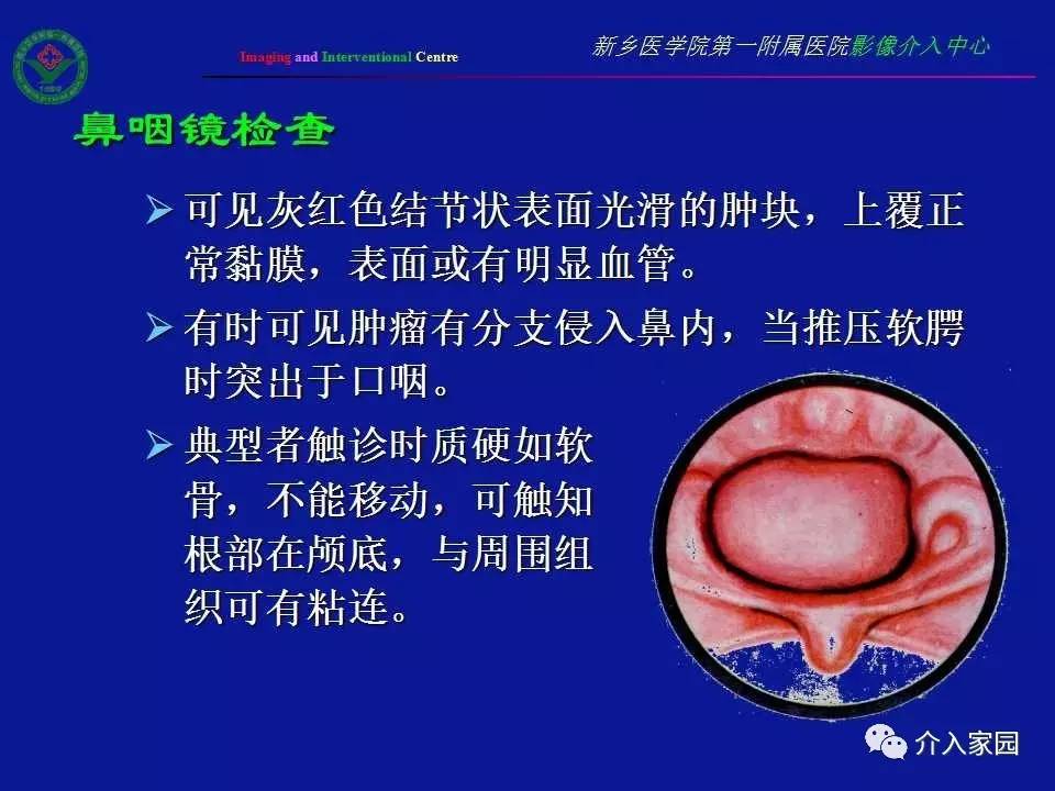 介入微课堂│鼻咽部纤维血管瘤影像学诊断与介入治疗