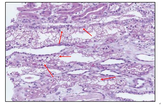 图22 he染色:使用钙调神经蛋白抑制剂后:红色箭头:集合管上皮细胞"等