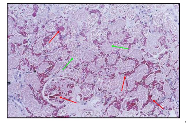肾内病理图解:缺血性和毒性急性肾小管损伤
