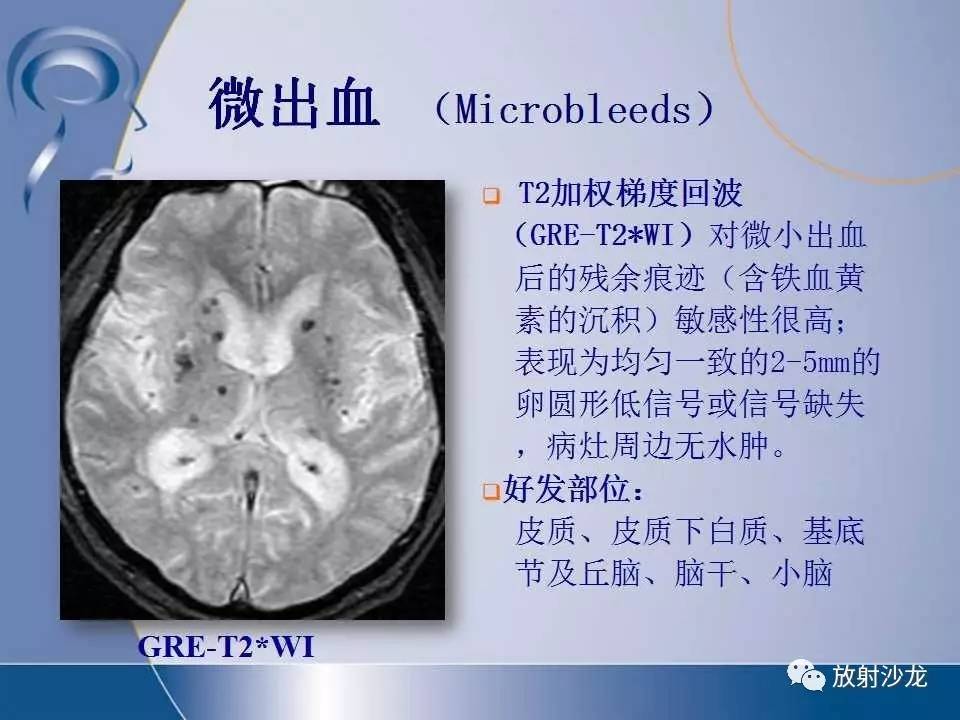 经典| 脑小血管病与腔隙性脑梗死