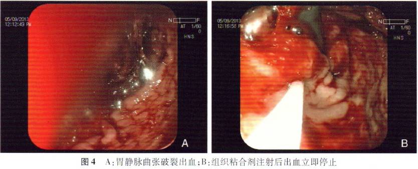 图文 食管胃静脉曲张破裂出血的内镜治疗