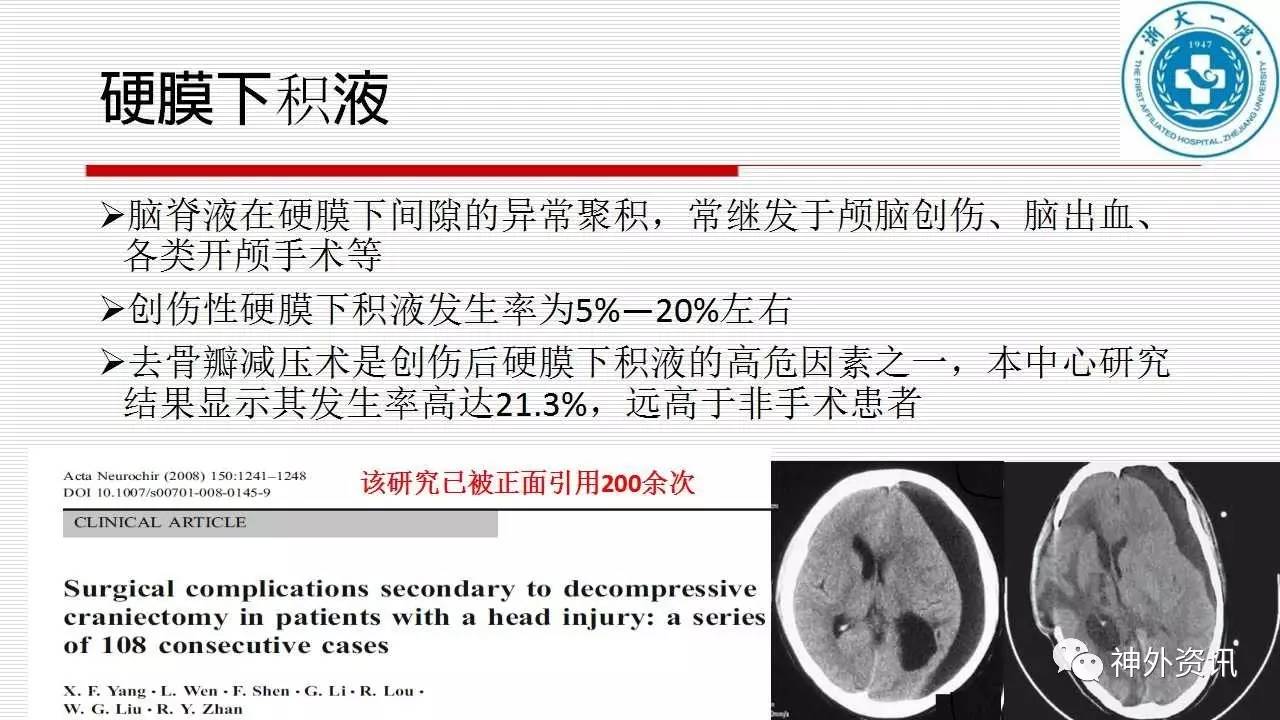 周刊(第12期)| 早期颅骨修补--去骨瓣减压术后硬膜下积液治疗的新选择