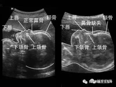 比如先心病,无脑儿,唇腭裂,脊柱裂等结构异常,筛查需要通过超声,核磁