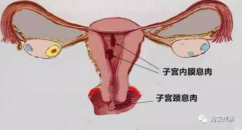 宫颈息肉复发怎么办