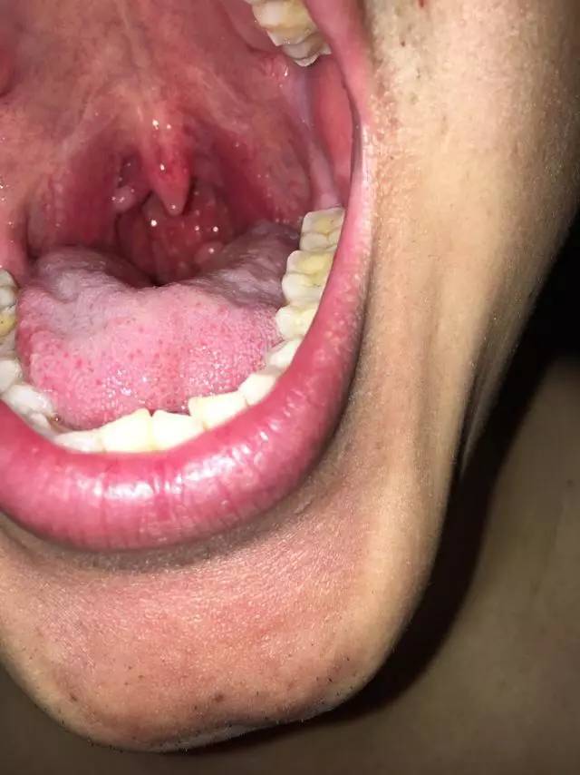 这个无需要质疑,这个属于喉咙疱疹,看看这个舌苔,湿热内盛.