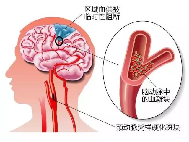 1/3的中国人颈部有这个斑,可引发脑梗!