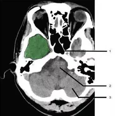 1,蝶窦(sphenoid sinus)