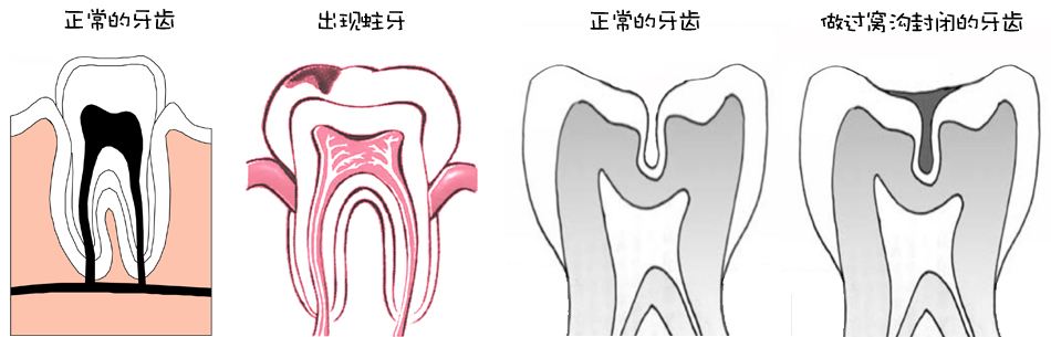 虫牙洞怎么办