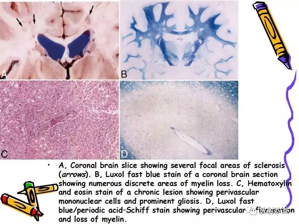 中枢神经系统——脱髓鞘疾病
