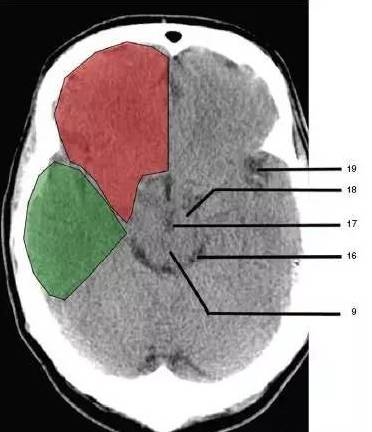 颅脑ct解剖,您get到了吗?