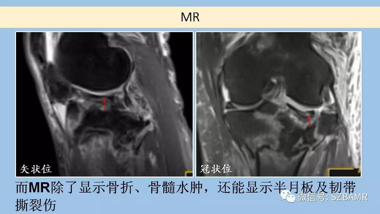 磁共振科普系列之半月板损伤