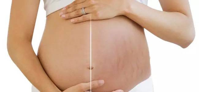 怀孕有妊娠纹怎么办