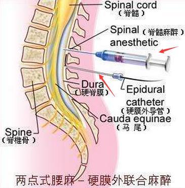 而腰硬联合麻醉是这样的:用一根长针把麻醉剂打入蛛网膜下腔,暂时