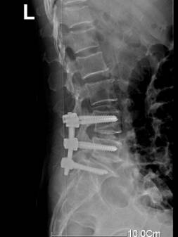 术后x光片 颈椎骨折 术前x光片