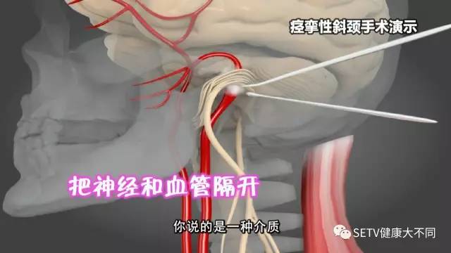 痉挛性斜颈的治疗原理_有病早治花的是小钱,有病拖着不治害的是身体,拖得严重了再治花的是