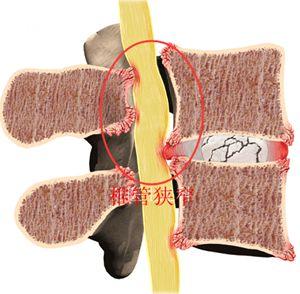 腰椎椎管狭窄症与腰椎间盘突出有什么不同怎么