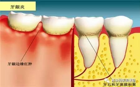 牙脚部分会有牙菌膜淤积,稍后齿龈和牙齿会出现逐渐分开.