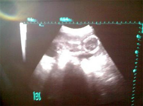 肚子里的胎宝宝4个月停胎,小月子里我泪流不止