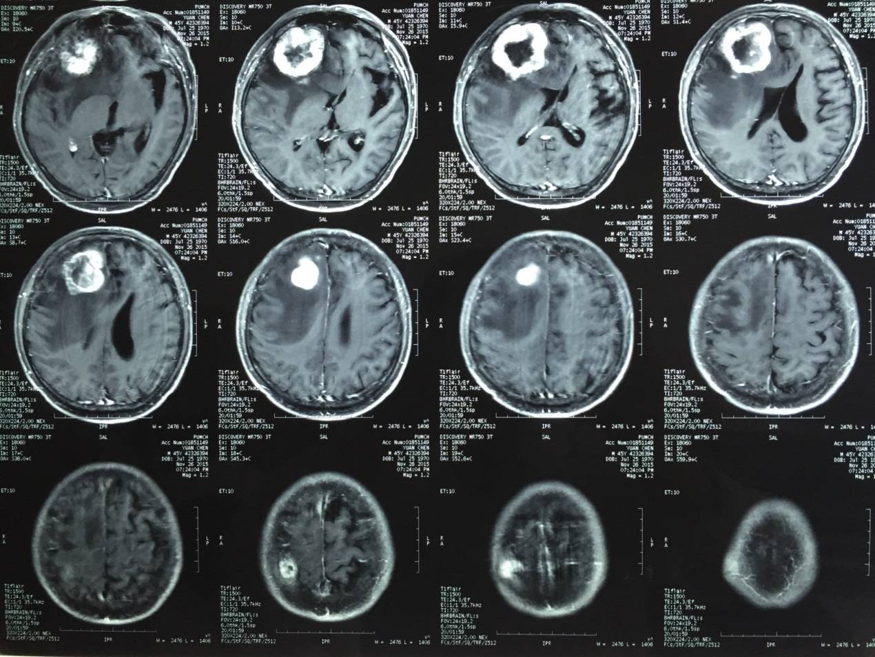 2015年12月4日行脑部手术:         病理切片