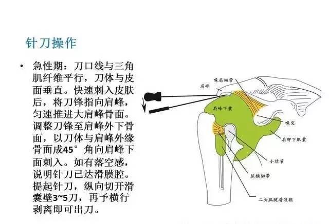 六大组成部分,十一种进针刀方法,重点传授各种软组织损伤,如肩周炎