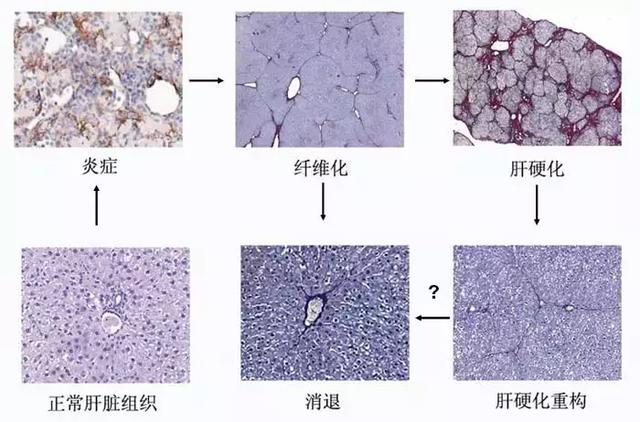 肝纤维化是一个处于发展变化中的病理过程,是慢性肝炎向肝硬化发展的