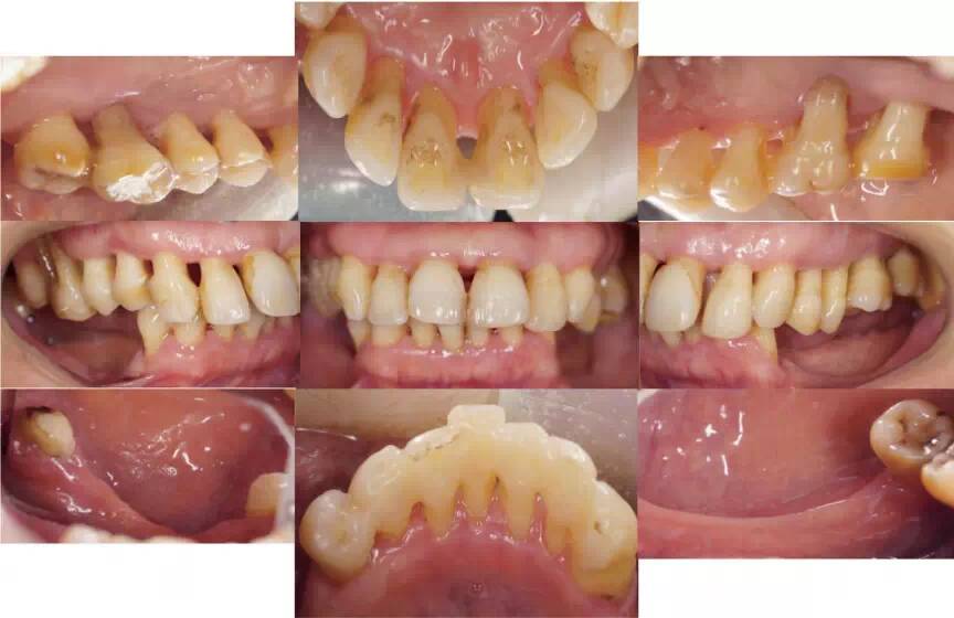 哈尔滨医科大学附属第四医院口腔科 病例1:一例重度慢性牙周炎患者