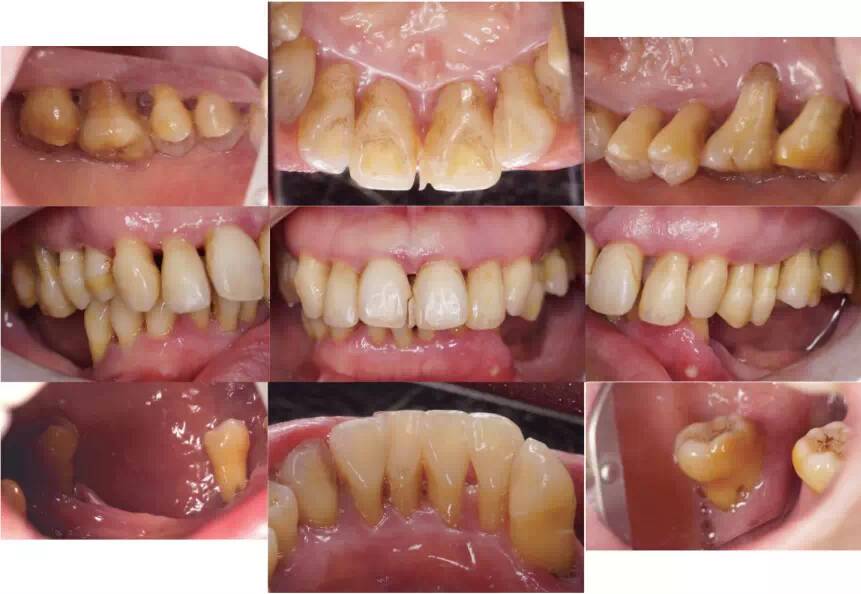 治疗后全口根尖片 病例2:一例侵袭性牙周炎患者的基础治疗前后对比