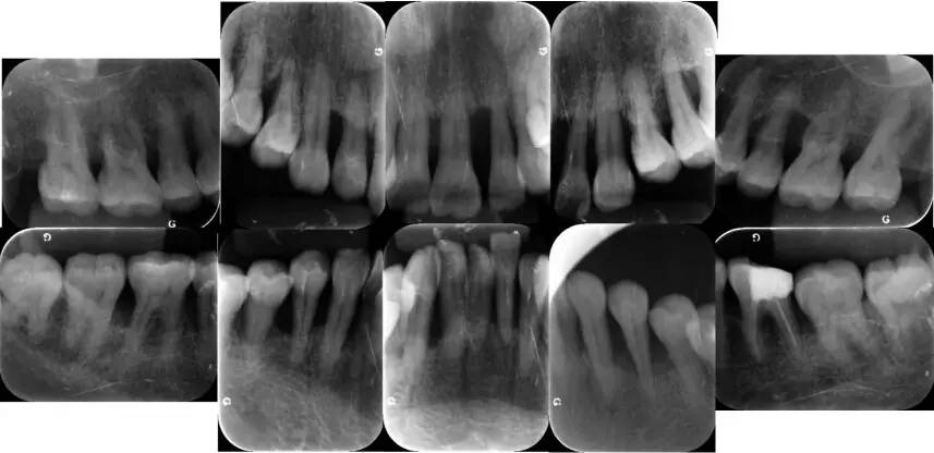 图5 基础治疗后全口根尖片 病例2:一例侵袭性牙周炎患者的基础治疗