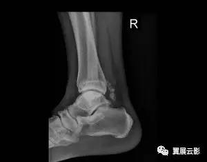 【影像病例】滑膜骨软骨瘤一例