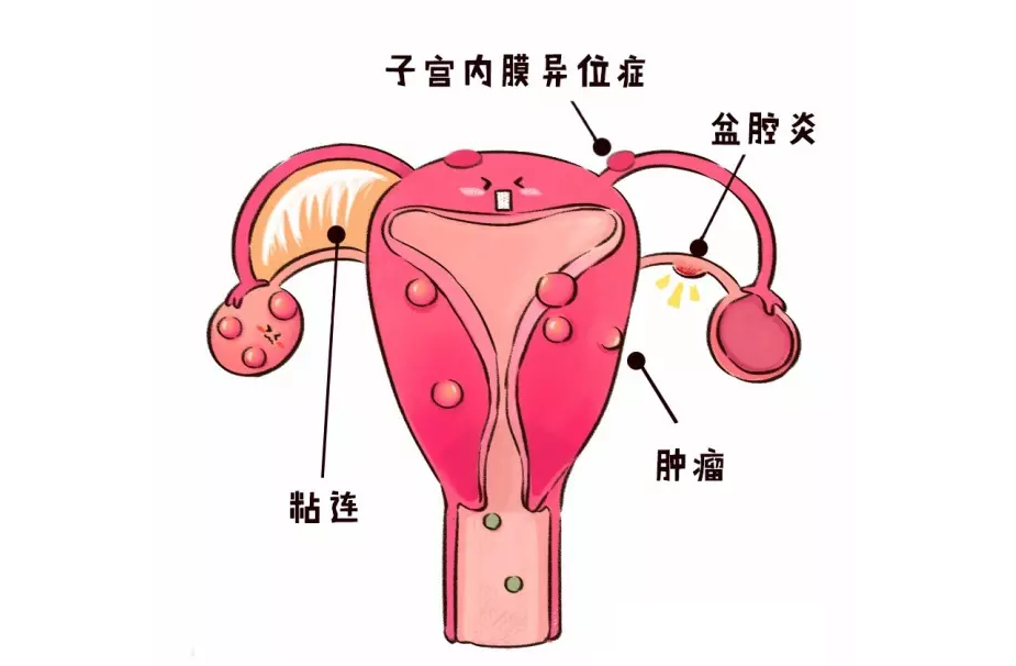 健康 正文  如果女性痛经是因为子宫位置不正常导致经血堆积,怀孕过程
